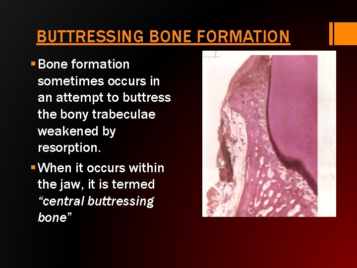BUTTRESSING BONE FORMATION § Bone formation sometimes occurs in an attempt to buttress the