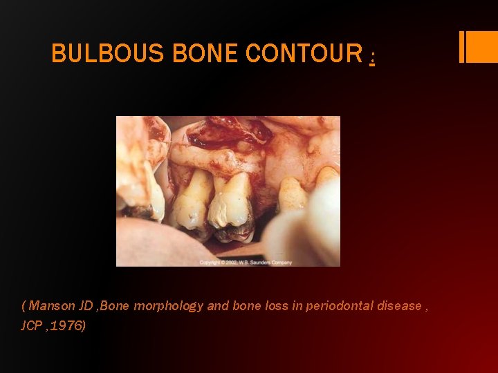 BULBOUS BONE CONTOUR : ( Manson JD , Bone morphology and bone loss in