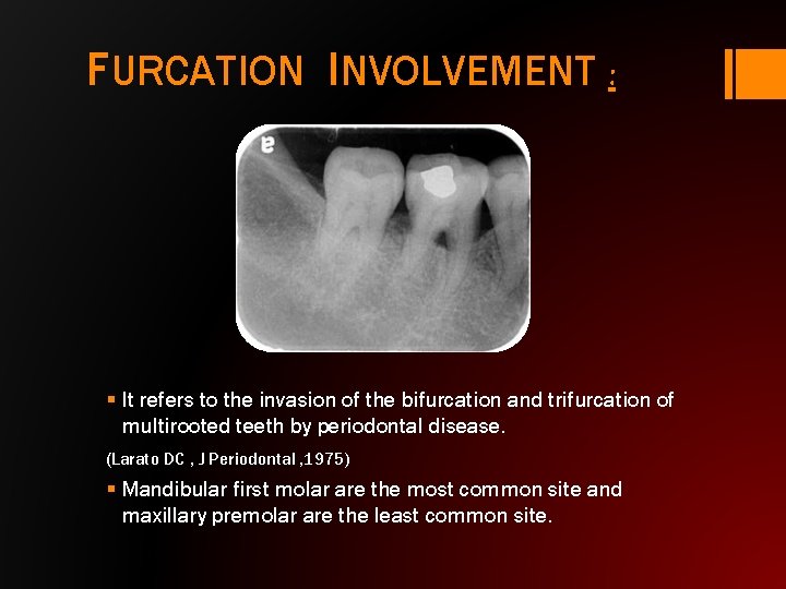 FURCATION INVOLVEMENT : § It refers to the invasion of the bifurcation and trifurcation