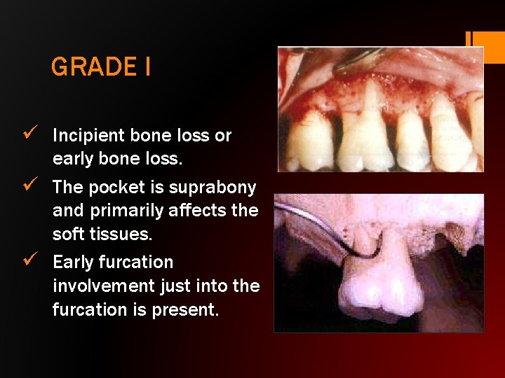 GRADE I ü Incipient bone loss or early bone loss. ü The pocket is