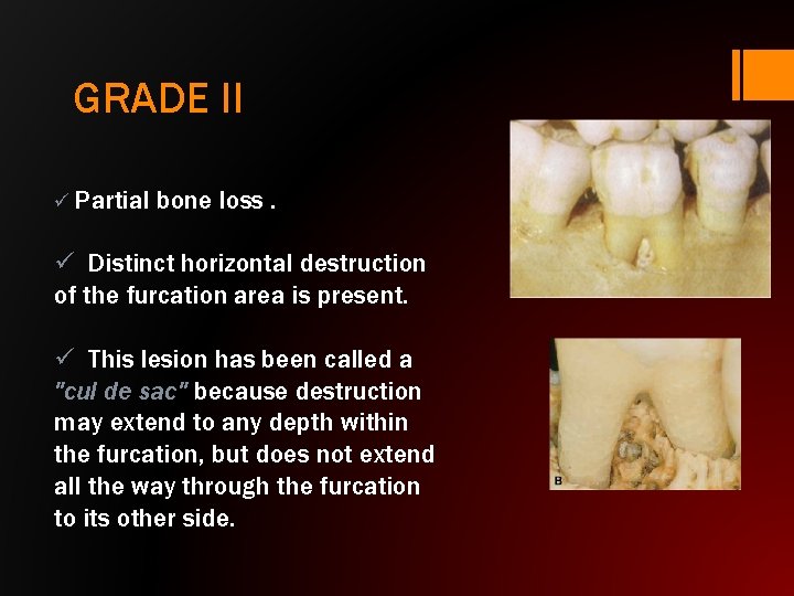 GRADE II ü Partial bone loss. ü Distinct horizontal destruction of the furcation area