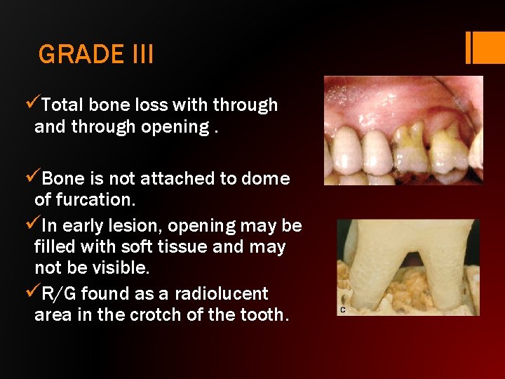 GRADE III üTotal bone loss with through and through opening. üBone is not attached