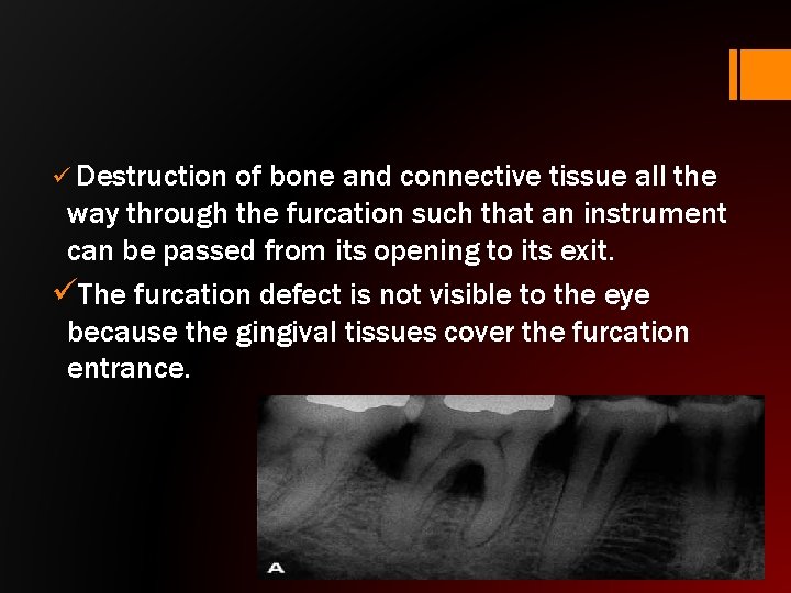 ü Destruction of bone and connective tissue all the way through the furcation such