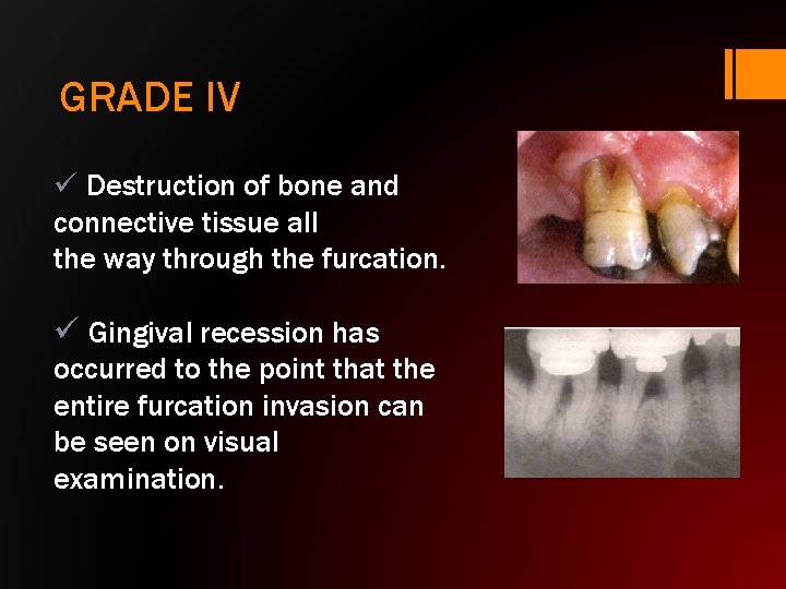 GRADE IV ü Destruction of bone and connective tissue all the way through the