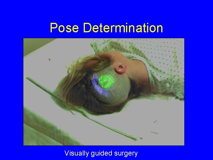 Pose Determination Visually guided surgery 