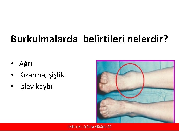Burkulmalarda belirtileri nelerdir? • Ağrı • Kızarma, şişlik • İşlev kaybı İZMİR İL İL