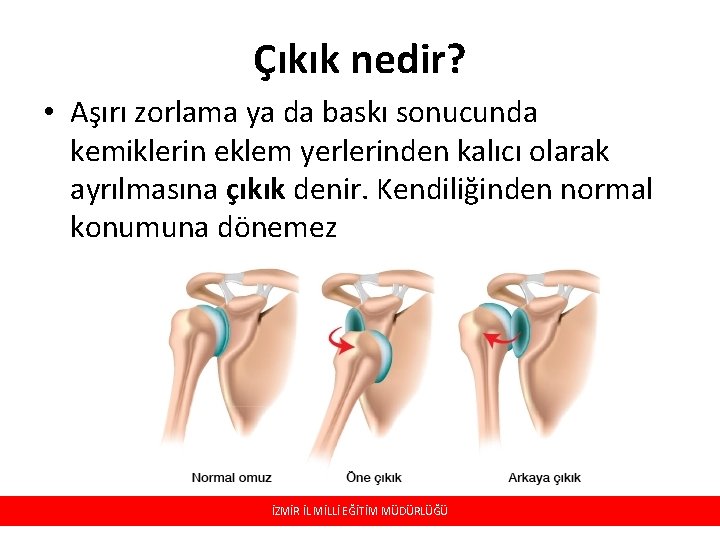 Çıkık nedir? • Aşırı zorlama ya da baskı sonucunda kemiklerin eklem yerlerinden kalıcı olarak