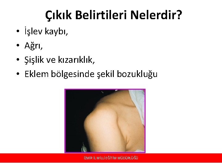 Çıkık Belirtileri Nelerdir? • • İşlev kaybı, Ağrı, Şişlik ve kızarıklık, Eklem bölgesinde şekil