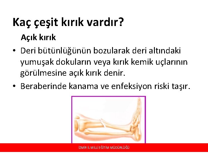 Kaç çeşit kırık vardır? Açık kırık • Deri bütünlüğünün bozularak deri altındaki yumuşak dokuların