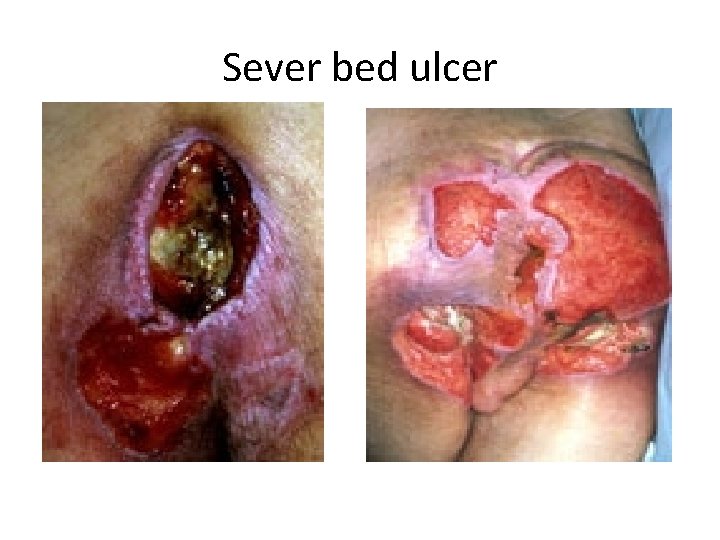 Sever bed ulcer 