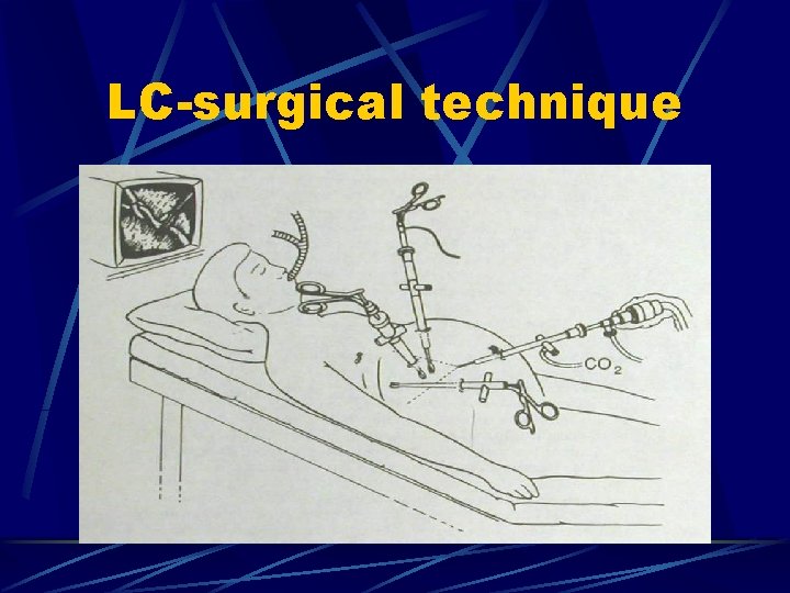 LC-surgical technique 