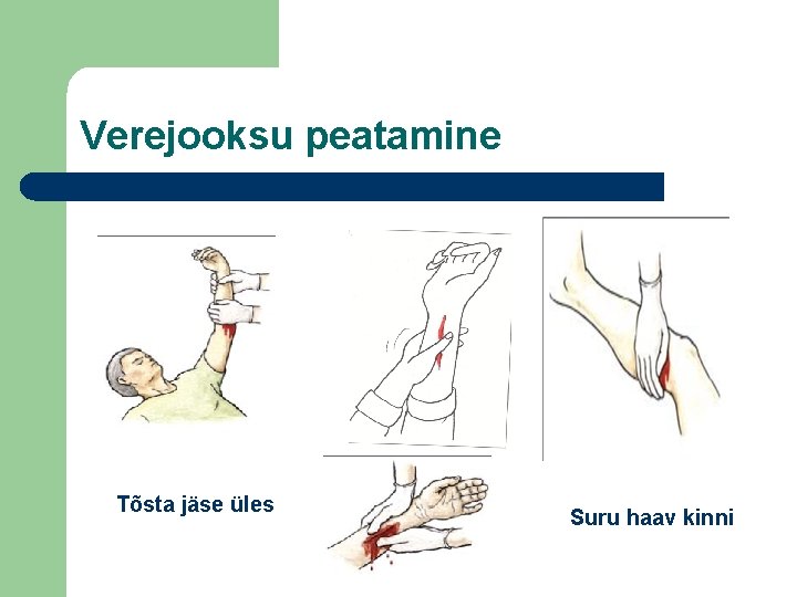 Verejooksu peatamine Tõsta jäse üles Suru haav kinni 