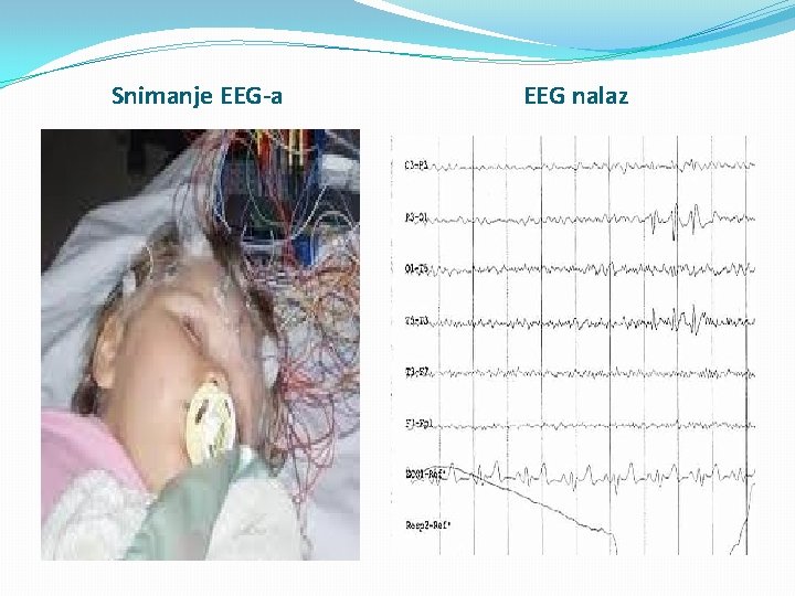 Snimanje EEG-a EEG nalaz 