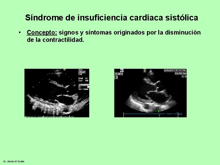 Síndrome de insuficiencia cardíaca sistólica • Concepto: signos y síntomas originados por la disminución