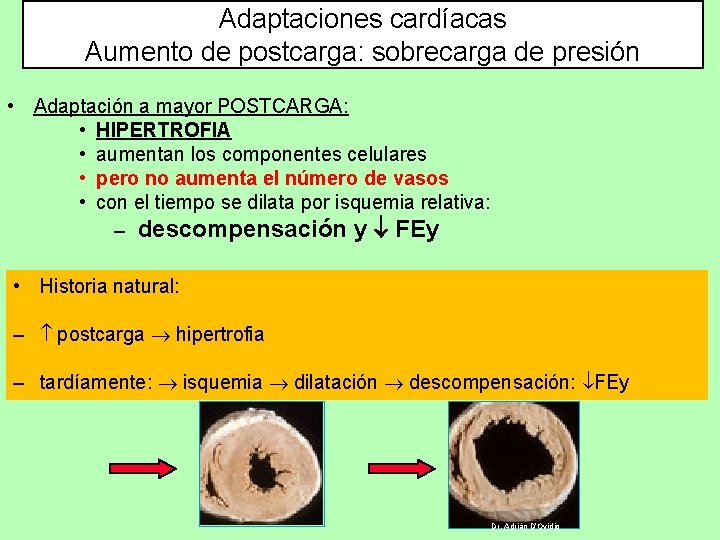 Adaptaciones cardíacas Aumento de postcarga: sobrecarga de presión • Adaptación a mayor POSTCARGA: •