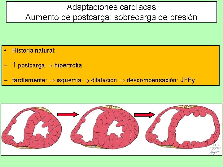 Adaptaciones cardíacas Aumento de postcarga: sobrecarga de presión • Historia natural: – postcarga hipertrofia