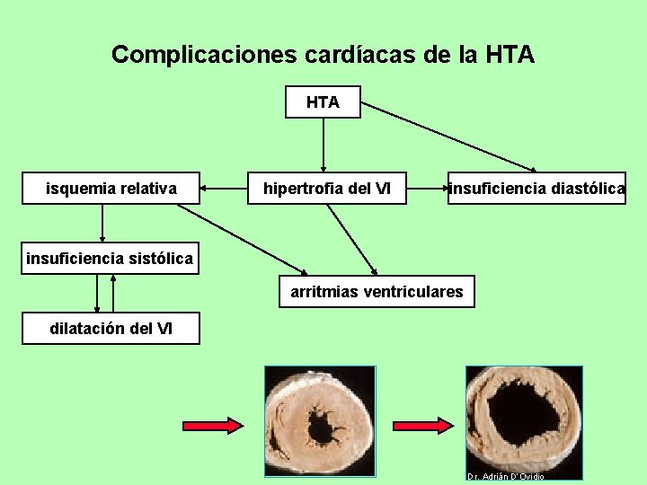 Complicaciones cardíacas de la HTA isquemia relativa hipertrofia del VI insuficiencia diastólica insuficiencia sistólica