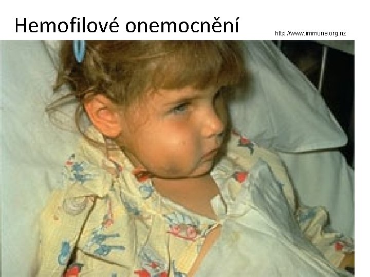 Hemofilové onemocnění http: //www. immune. org. nz 