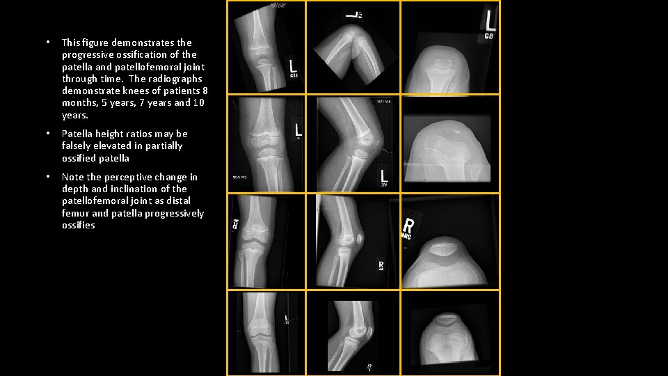  • This figure demonstrates the progressive ossification of the patella and patellofemoral joint