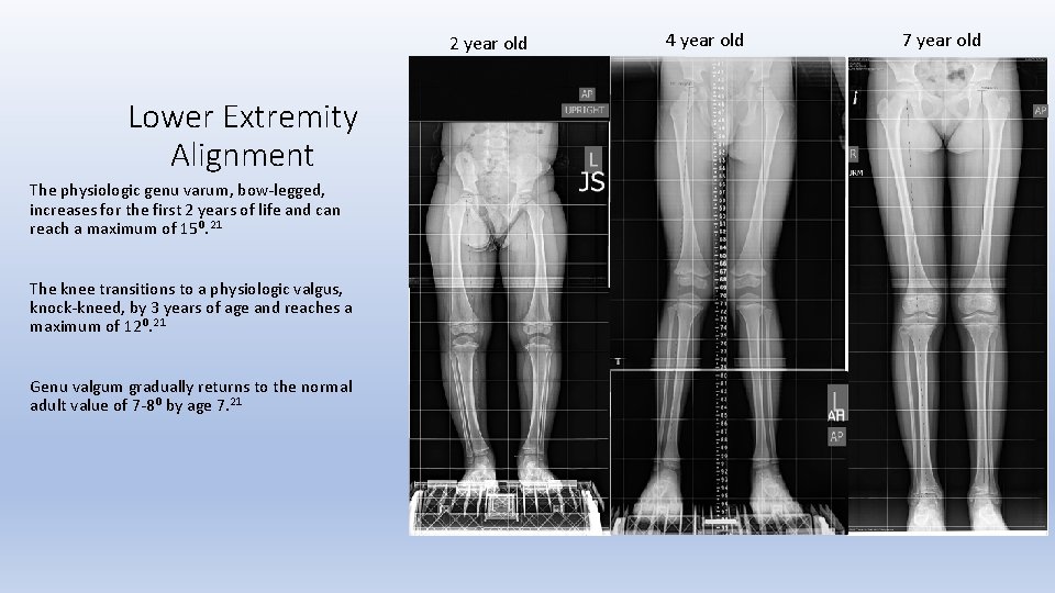 2 year old Lower Extremity Alignment The physiologic genu varum, bow-legged, increases for the