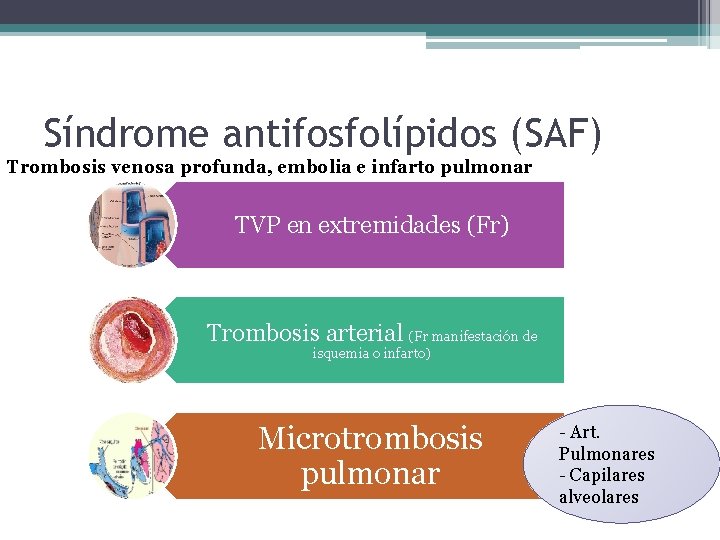 Síndrome antifosfolípidos (SAF) Trombosis venosa profunda, embolia e infarto pulmonar TVP en extremidades (Fr)