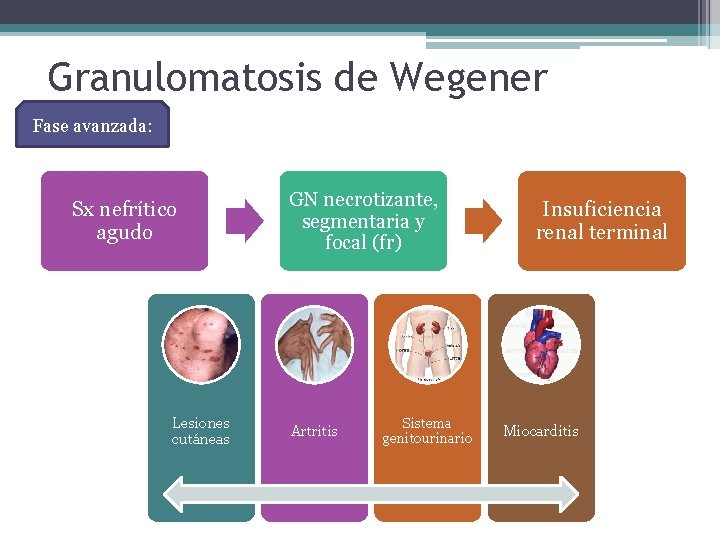 Granulomatosis de Wegener Fase avanzada: Sx nefrítico agudo Lesiones cutáneas GN necrotizante, segmentaria y
