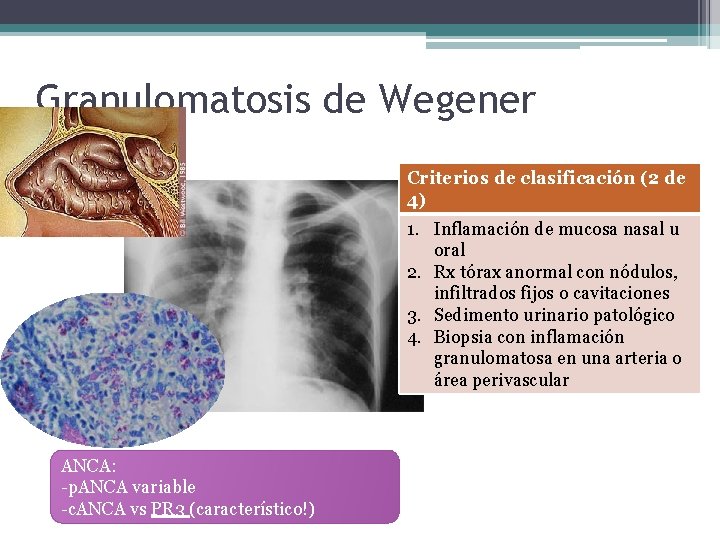 Granulomatosis de Wegener Criterios de clasificación (2 de 4) 1. Inflamación de mucosa nasal