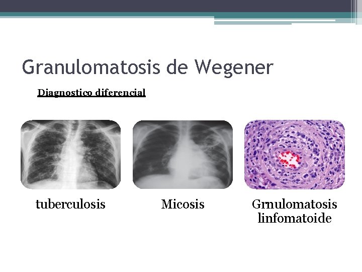 Granulomatosis de Wegener Diagnostico diferencial tuberculosis Micosis Grnulomatosis linfomatoide 