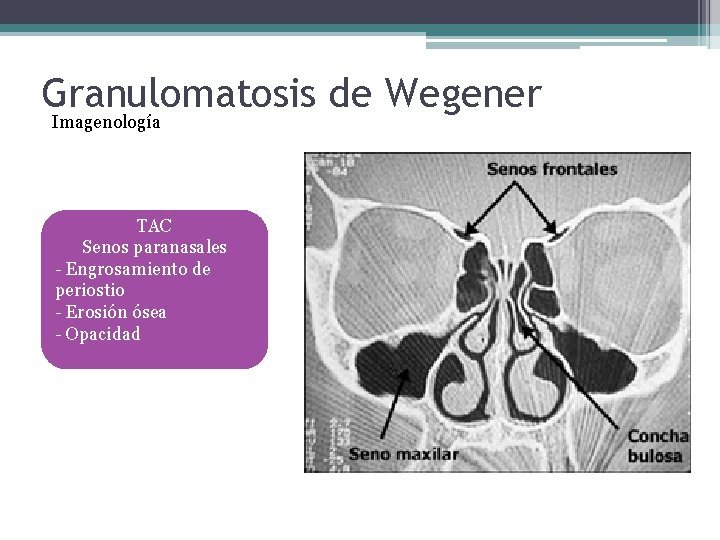 Granulomatosis de Wegener Imagenología TAC Senos paranasales - Engrosamiento de periostio - Erosión ósea