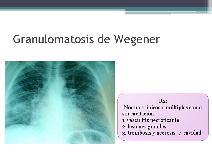 Granulomatosis de Wegener Rx: -Nódulos únicos o múltiples con o sin cavitación 1. vasculitis