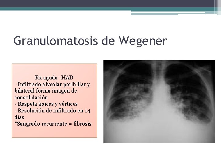 Granulomatosis de Wegener Rx aguda -HAD - Infiltrado alveolar perihiliar y bilateral forma imagen