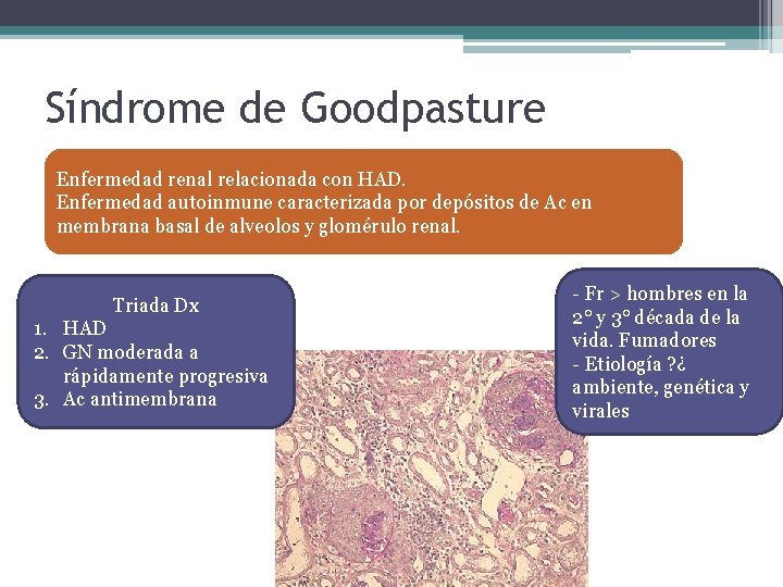 Síndrome de Goodpasture Enfermedad renal relacionada con HAD. Enfermedad autoinmune caracterizada por depósitos de