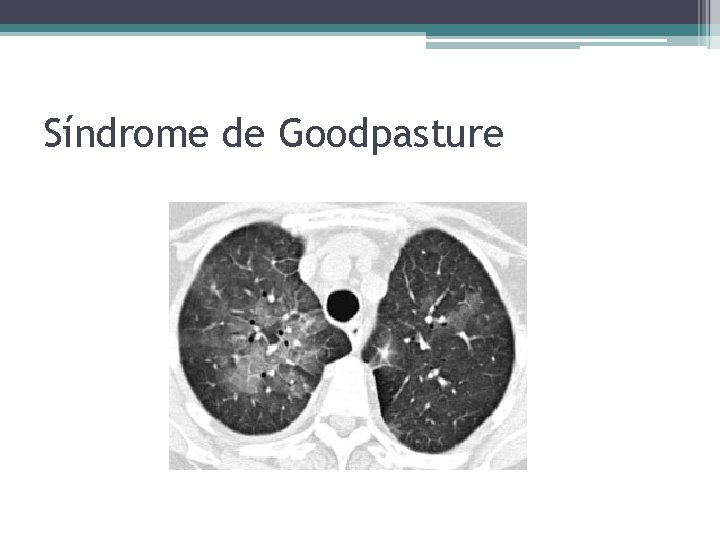Síndrome de Goodpasture 