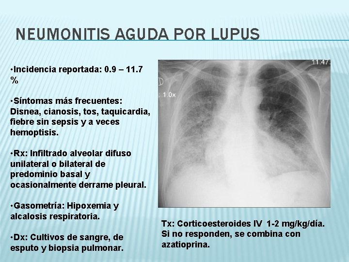 NEUMONITIS AGUDA POR LUPUS • Incidencia reportada: 0. 9 – 11. 7 % •