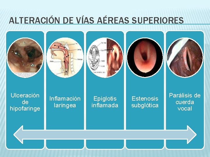 ALTERACIÓN DE VÍAS AÉREAS SUPERIORES Ulceración de hipofaringe Inflamación laríngea Epiglotis inflamada Estenosis subglótica