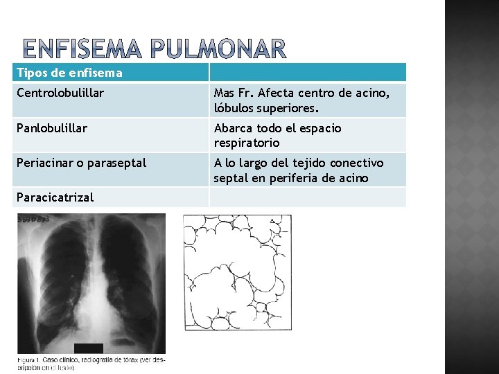 Tipos de enfisema Centrolobulillar Mas Fr. Afecta centro de acino, lóbulos superiores. Panlobulillar Abarca