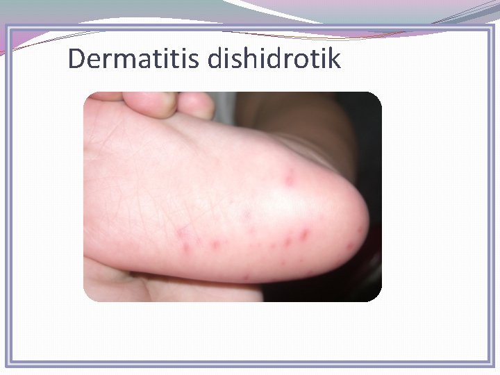 Dermatitis dishidrotik 