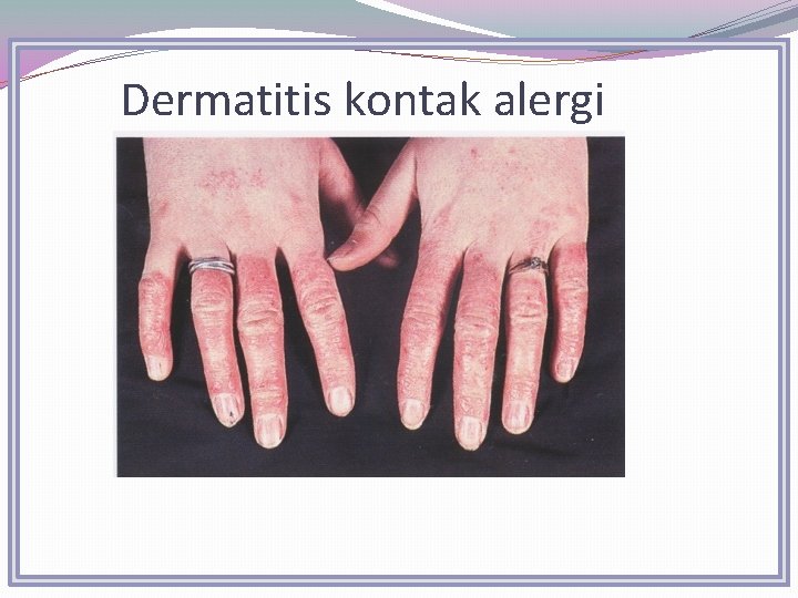 Dermatitis kontak alergi 