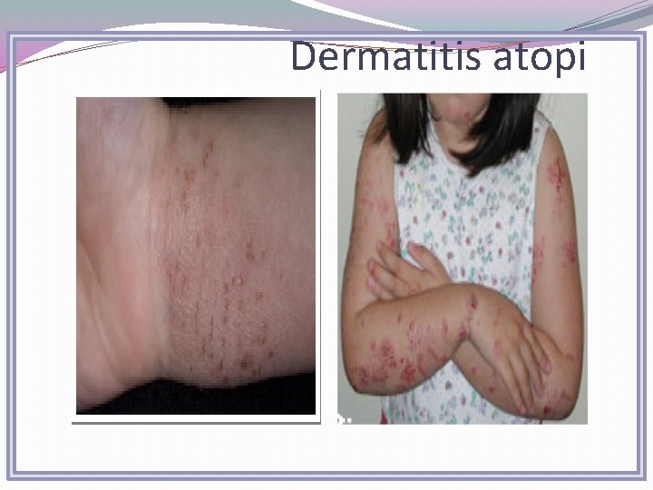 Dermatitis atopi 