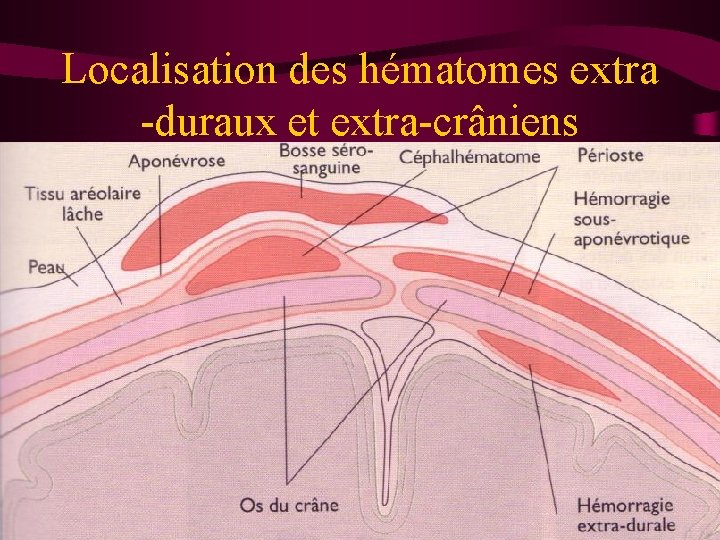 Localisation des hématomes extra -duraux et extra-crâniens 