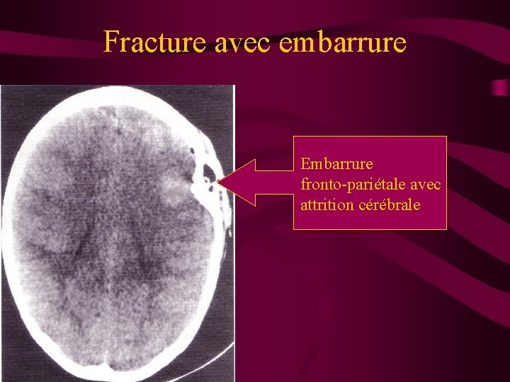 Fracture avec embarrure Embarrure fronto-pariétale avec attrition cérébrale 