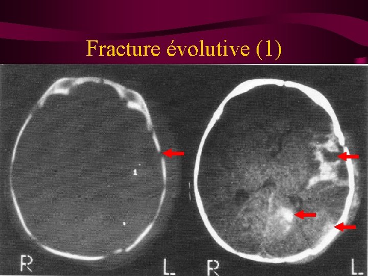 Fracture évolutive (1) 