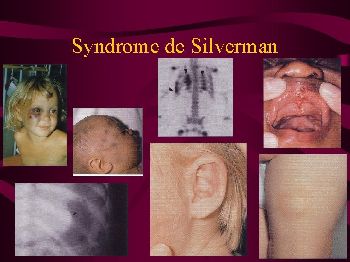 Syndrome de Silverman 