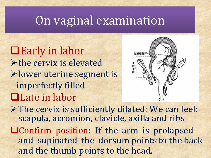 On vaginal examination q. Early in labor Ø the cervix is elevated Ø lower