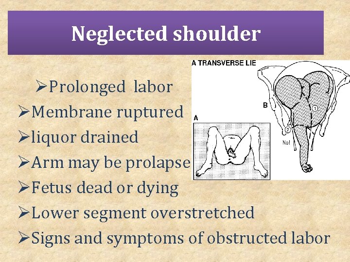Neglected shoulder ØProlonged labor ØMembrane ruptured Øliquor drained ØArm may be prolapsed ØFetus dead