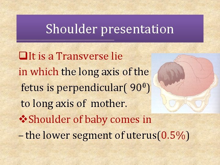 Shoulder presentation q. It is a Transverse lie in which the long axis of