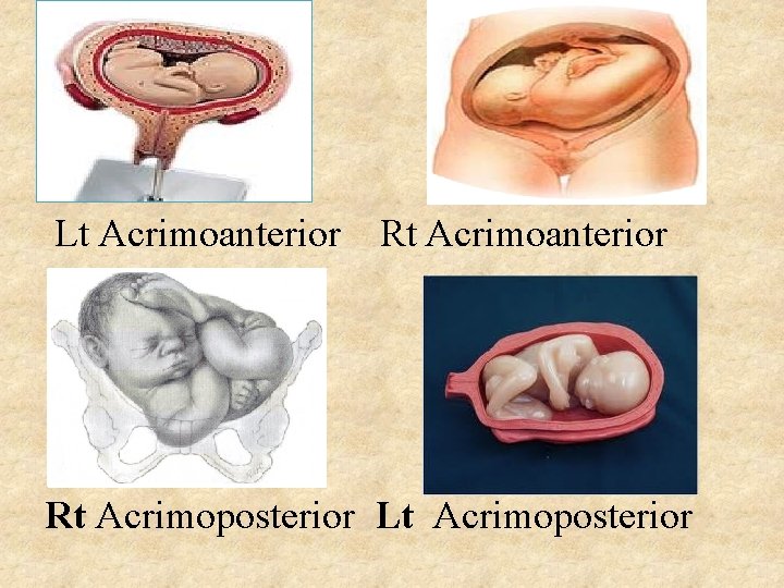 Lt Acrimoanterior Rt Acrimoposterior Lt Acrimoposterior 