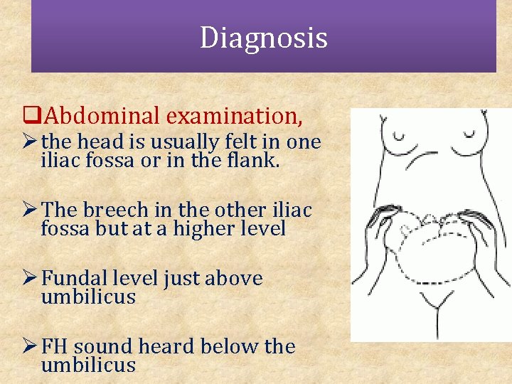 Diagnosis q. Abdominal examination, Ø the head is usually felt in one iliac fossa