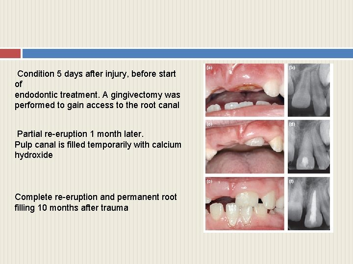 Condition 5 days after injury, before start of endodontic treatment. A gingivectomy was performed