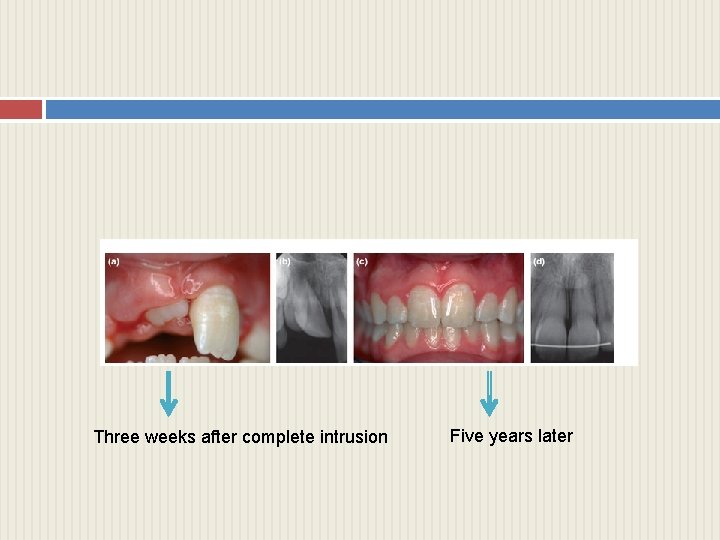 Three weeks after complete intrusion Five years later 